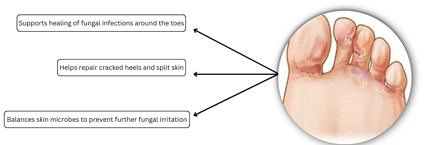 _Heals Fungal Infections & Toes Area