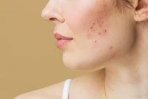 what causes acne