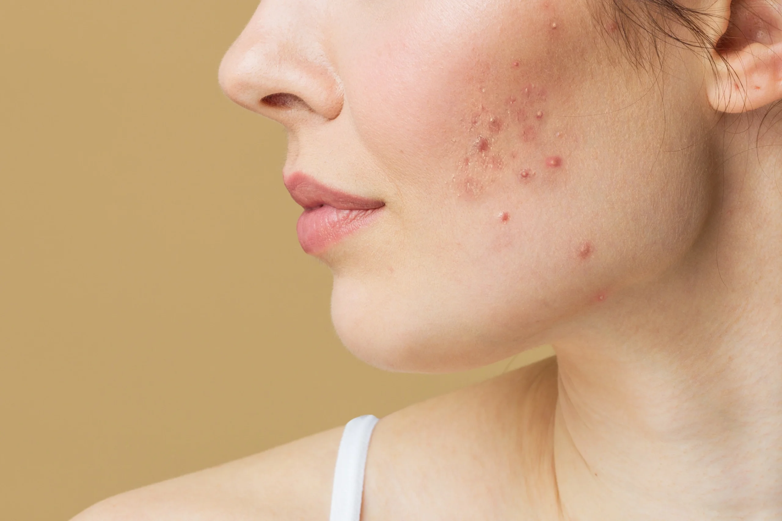 what causes acne