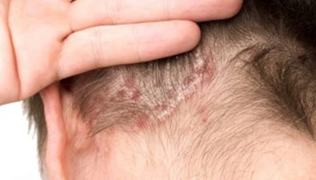 Scalp Health